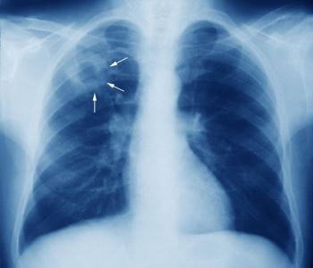 Pour renforcer le dépistage et le traitement préventif de la tuberculose